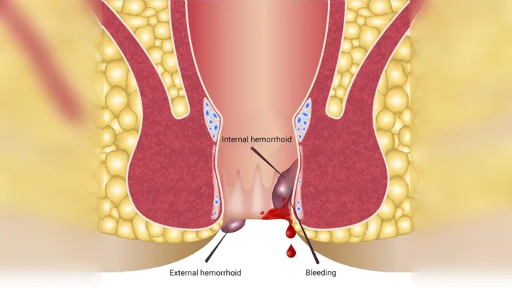 Bethsaida Hospital Serang Tawarkan Solusi Canggih Atasi Wasir dengan Teknologi Laser