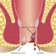 Hemorrhoid