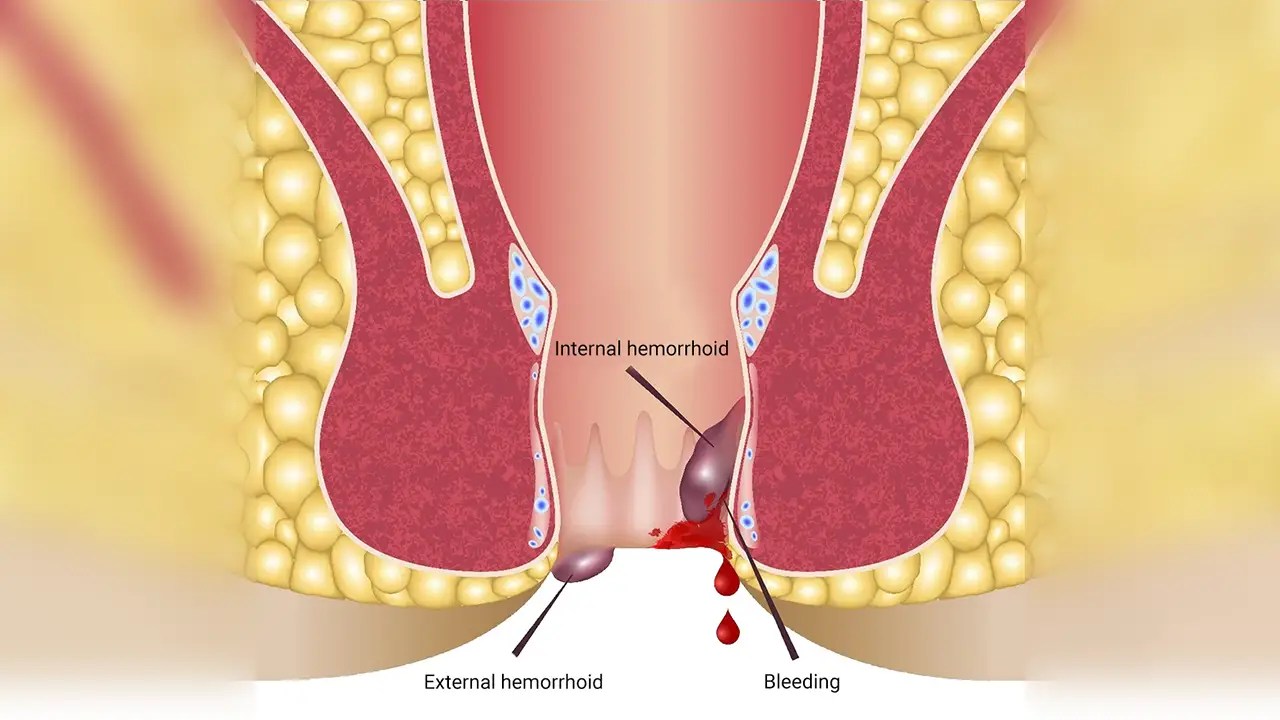 Hemorrhoid