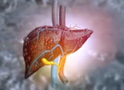 Hepatosteatosis Penyakit Hati Berlemak yang Perlu Diwaspadai