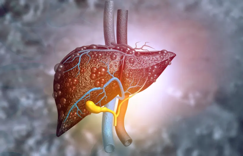 Hepatosteatosis